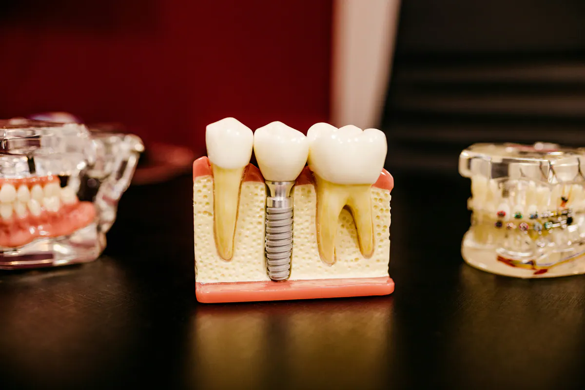 Model dentar care ilustrează poziția unui implant